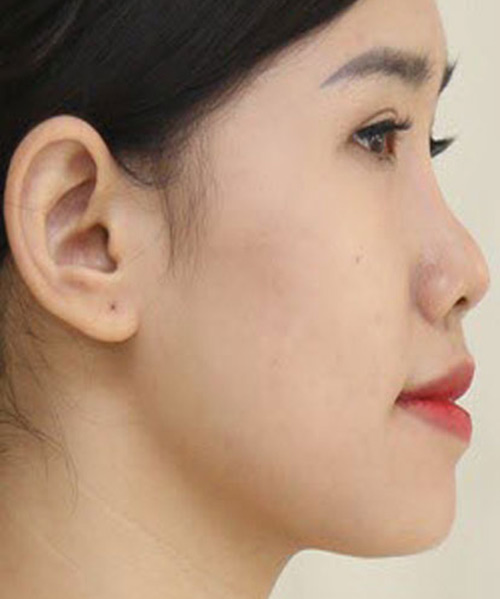 Người có dáng mũi tẹt được đánh giá là kém sang và thiếu cân đối gương mặt