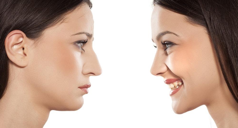 High-Line nose standard shape before and after