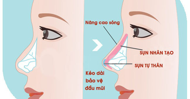 Khắc phục tình trạng nâng mũi không hợp sụn là bạn phải tháo bỏ sụn cũ 