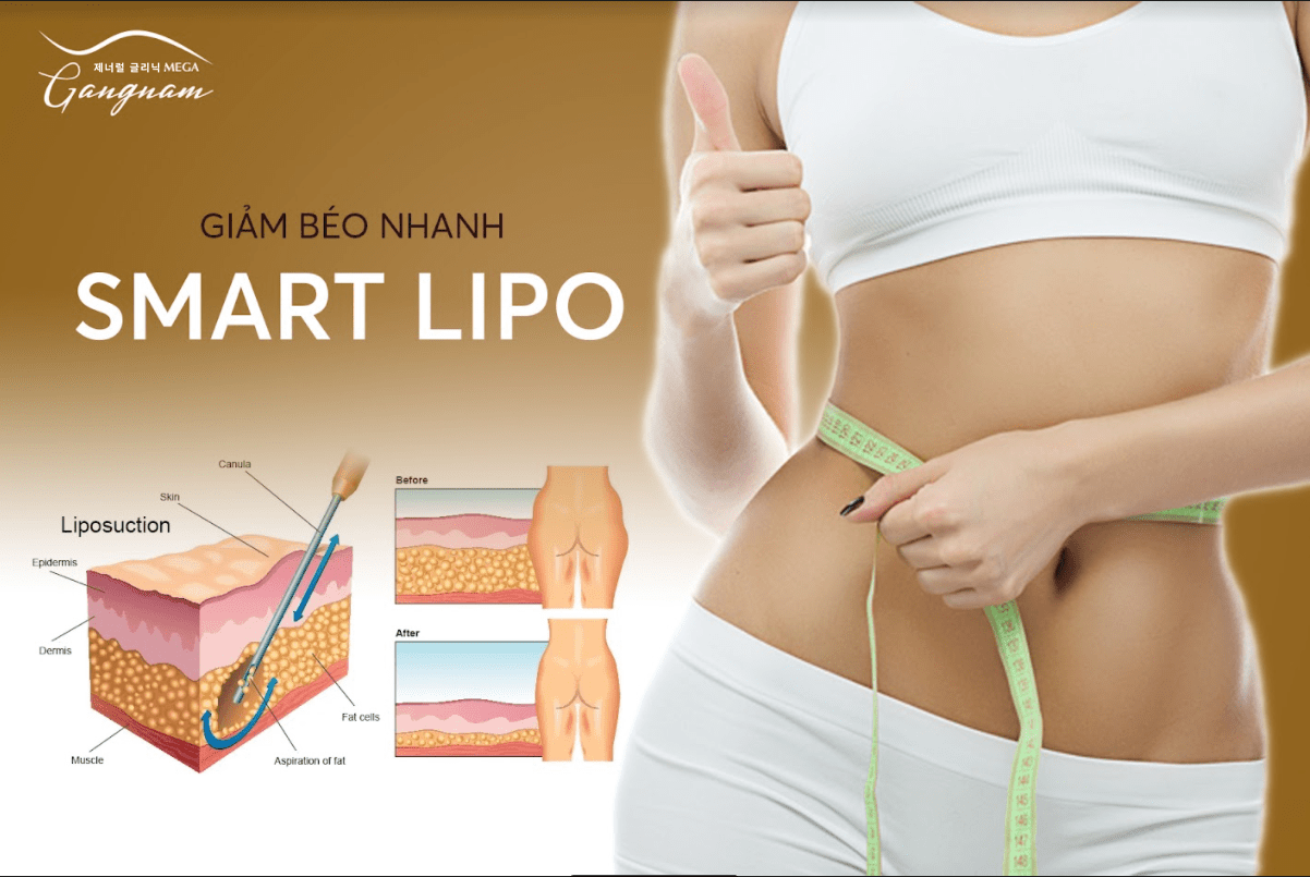 Giảm cân hiệu quả chỉ 1 liệu trình cùng với Smart Lipo