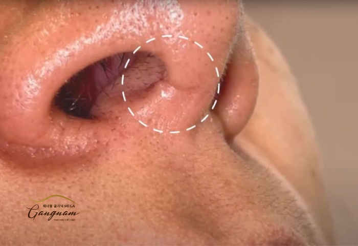 Đặc điểm nhận dạng các vết sẹo sau khi phẫu thuật nâng mũi