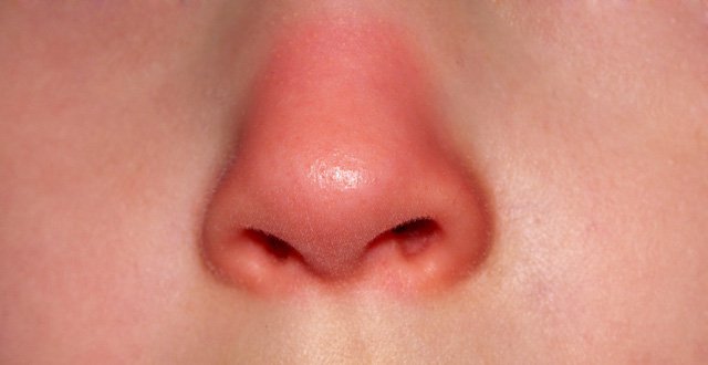 Tình trạng mũi bị phản ứng với các tinh chất nâng mũi 