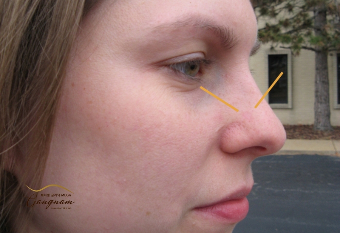 Đỏ đầu mũi nếu không do viêm hoặc nhiễm trùng có thể biến mất sau 1-2 tuần