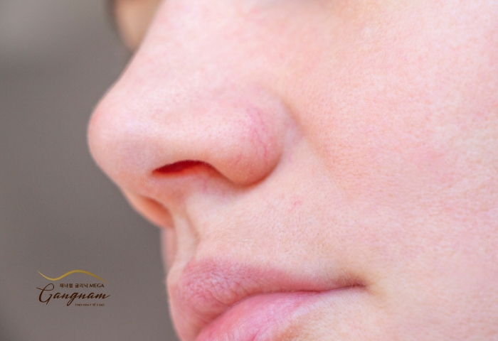 Các phương pháp giảm hiện tượng đầu mũi bị đỏ sau khi nâng mũi