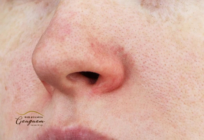 Một số nguyên nhân khiến đầu mũi bị đỏ sau khi nâng