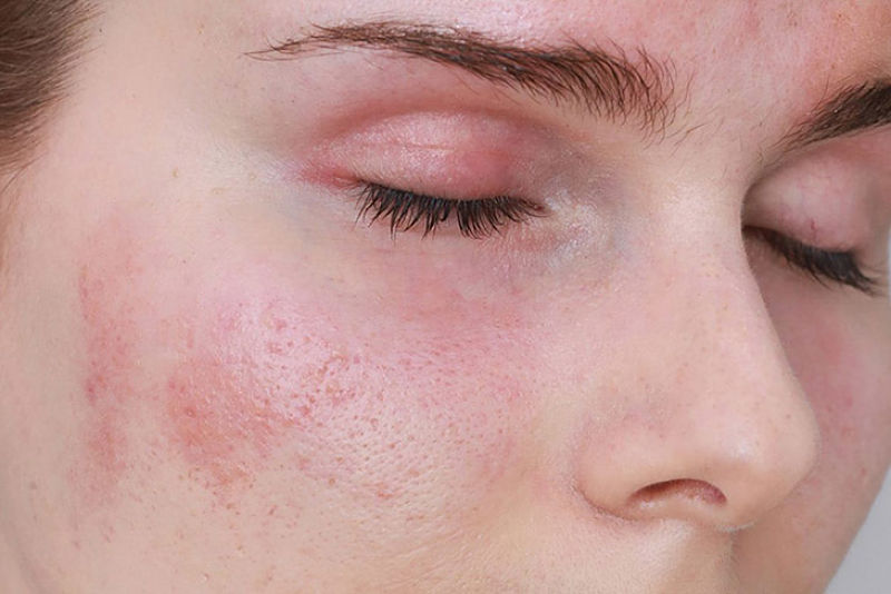 Hiện tượng da mặt bị đỏ không ngứa nguyên nhân trực tiếp là gì?