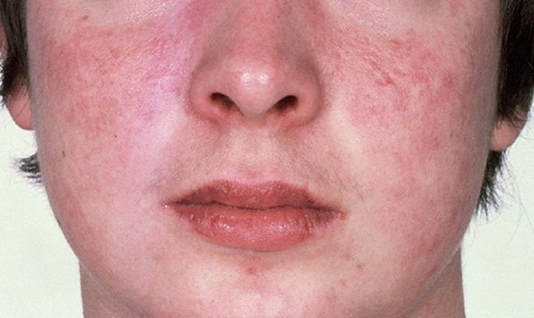 Da mặt đỏ không ngứa có thể do cháy nắng, giãn mao mạch, dị ứng nhẹ hoặc bệnh ngoài da