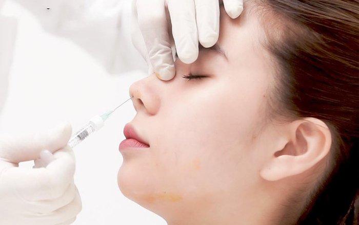 Những lý do nên lựa chọn phương pháp nâng mũi bằng chỉ sinh học collagen