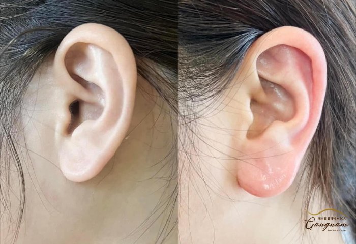 Tiêm tai tài lộc có tốt không?
