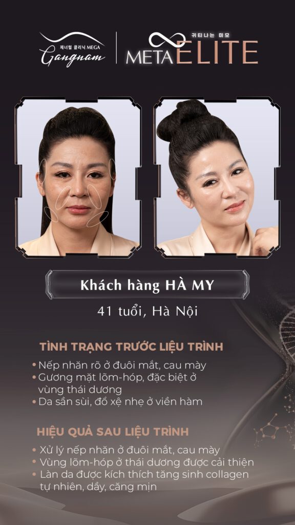 Chị Hà My (41 tuổi) sau khi trẻ hóa da mặt bằng phương pháp Meta Elite