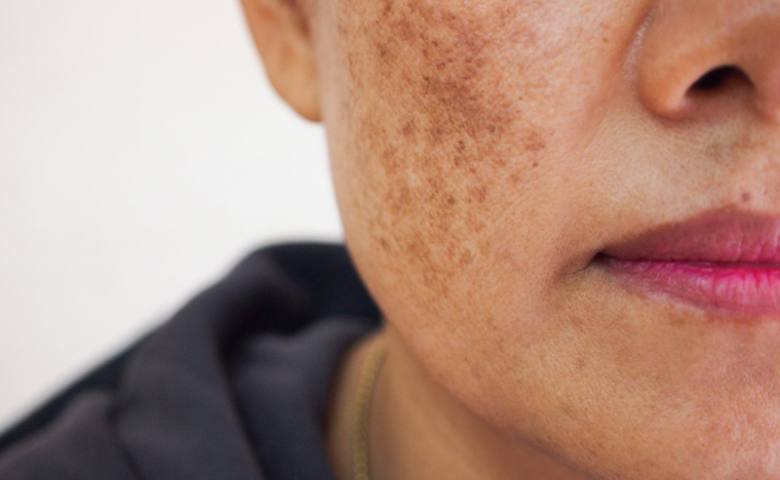 Một số công nghệ có khả năng điều trị vết thâm trên da mặt