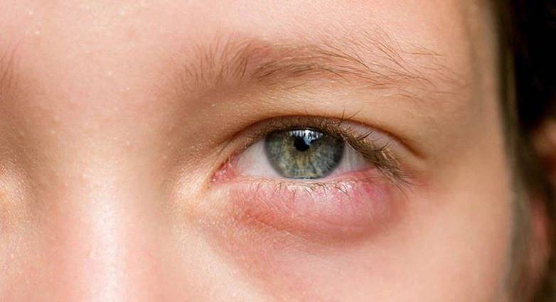 Bọng mắt bị giật có thể là cảnh báo về vấn đề sức khỏe