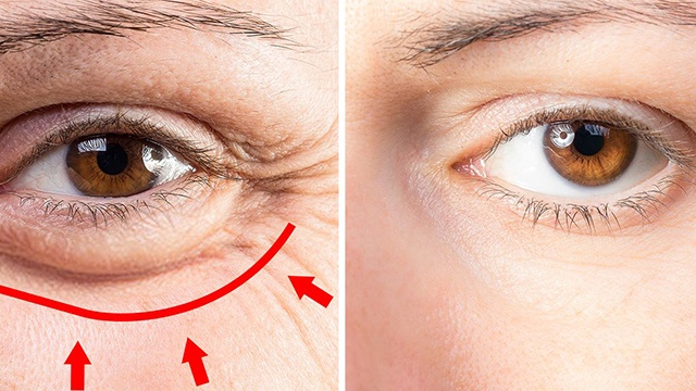 Bọng mỡ mắt xuất hiện do nguyên nhân lão hóa và các bệnh lý