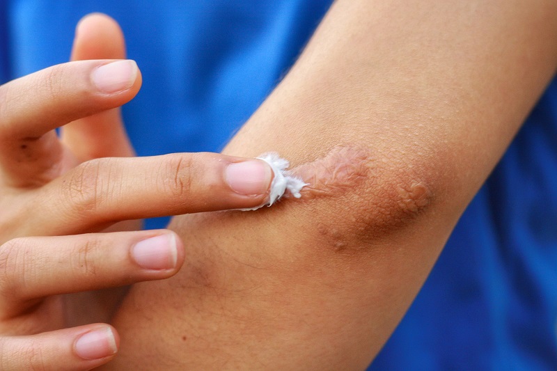 Các trường hợp có thể sử dụng kem bôi ngoài da để trị thâm sẹo