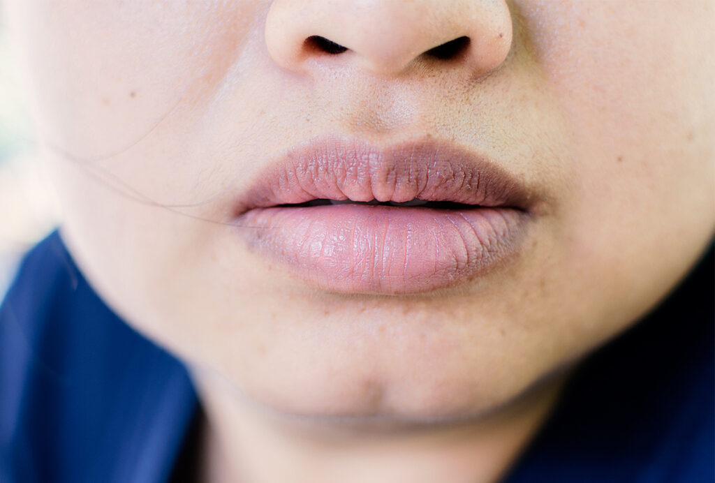 Một số trường hợp các vùng thâm môi sẽ mờ nhạt dần nhưng không phải tất cả