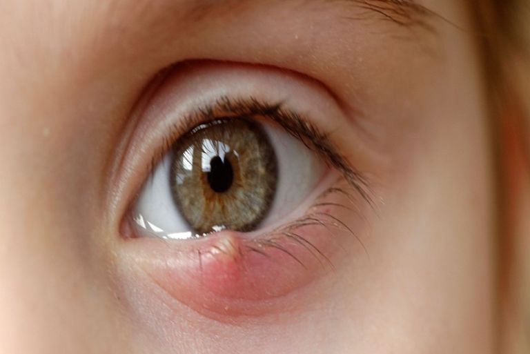 Yếu tố bệnh lý vùng bọng mắt