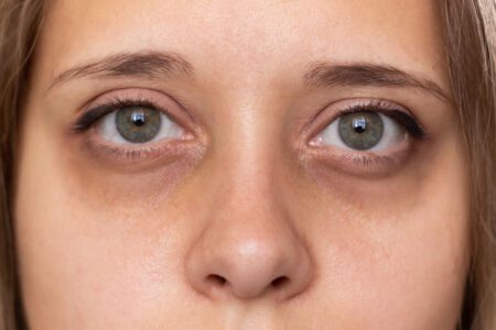 Nguyên nhân khiến vùng da dưới mắt thâm quầng