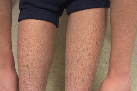 Tình trạng da khô và tăng sắc tố là một trong những bệnh hiếm gặp và khó chữa