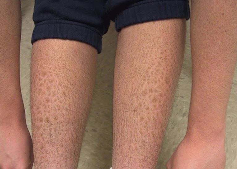 Tình trạng da khô và tăng sắc tố là một trong những bệnh hiếm gặp và khó chữa