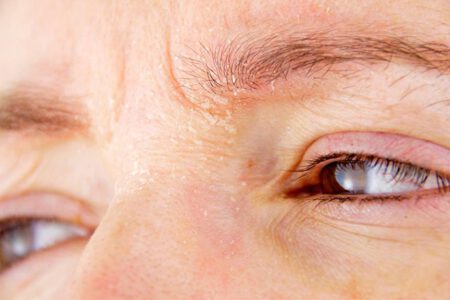 Nguyên nhân khiến vùng da mắt bị khô