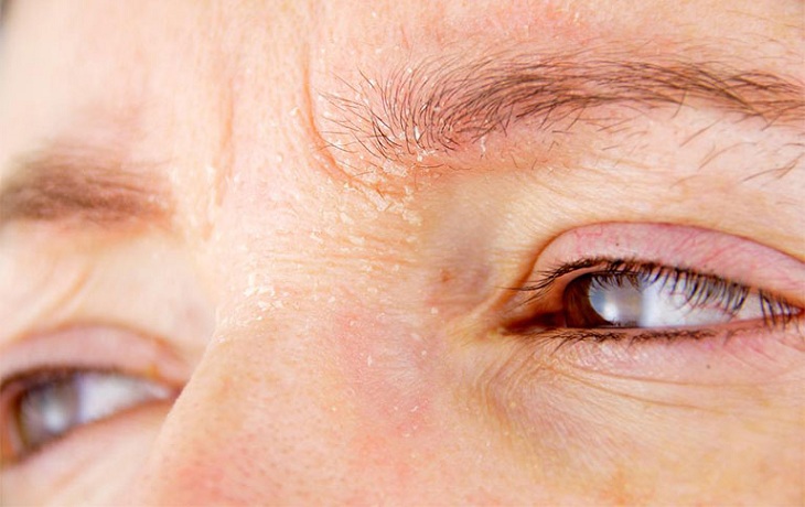 Nguyên nhân khiến vùng da mắt bị khô