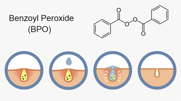 Benzoyl Peroxide: hỗ trợ điều trị mụn viêm sưng, mụn bọc