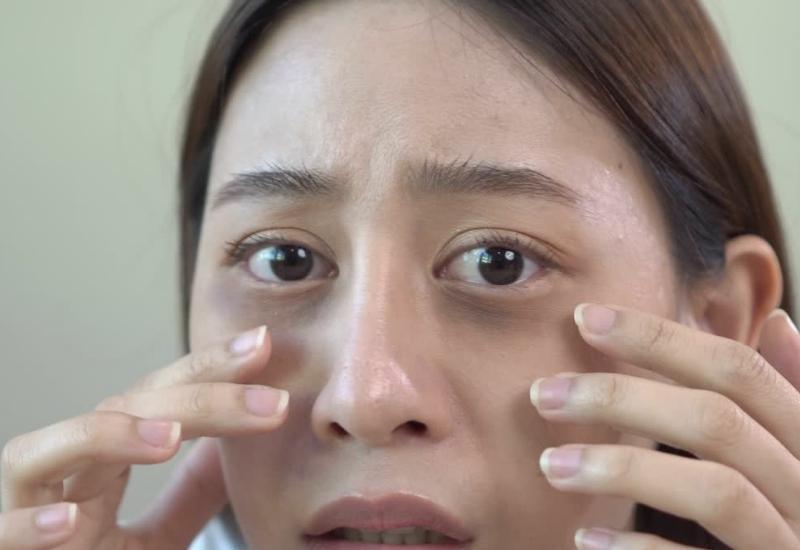 Tình trạng mắt thâm quầng là biểu hiện của bệnh lý gì? 