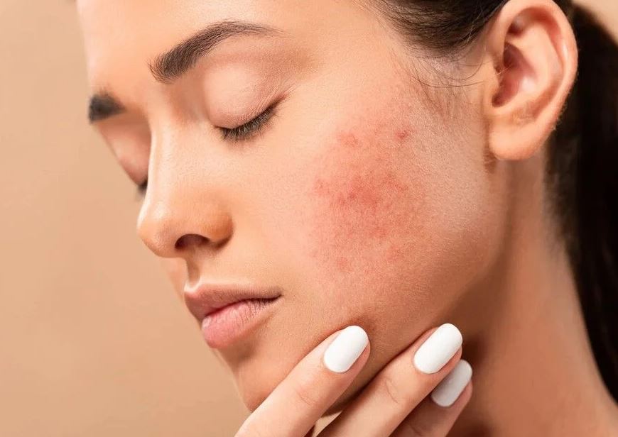 Tình trạng da mặt đang có dấu hiệu viêm sẽ làm tăng nguy cơ nổi mụn đỏ nếu tiếp tục triệt lông