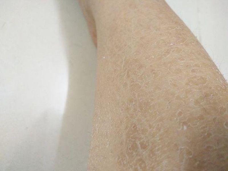 Tình trạng da chân khô tạo thành đường vân trên da 