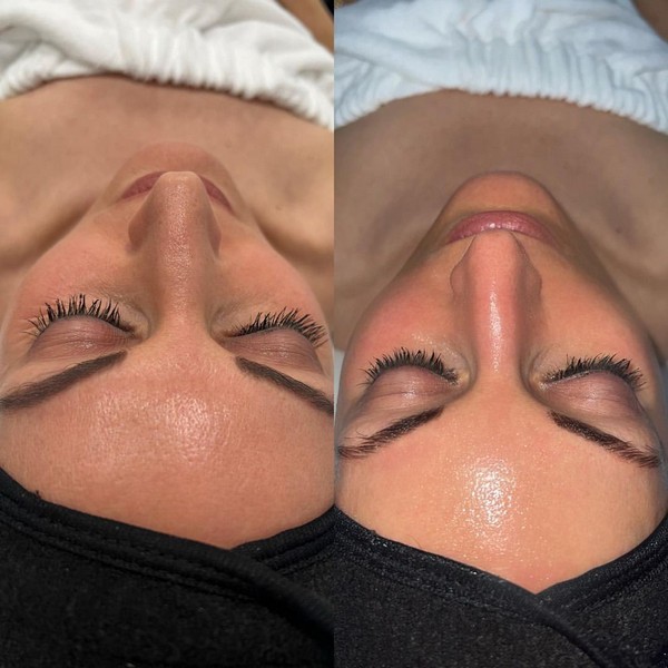 Công nghệ Hydrafacial cấp ẩm vượt trội cho da