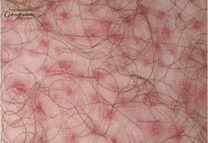 Nguyên nhân gây viêm nang lông vùng kín