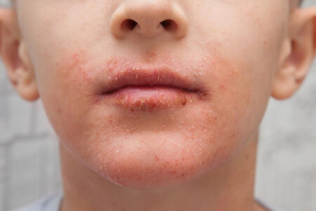 Tình trạng da quanh miệng khô rát có thể đến từ các bệnh lý và thói quen thường gặp