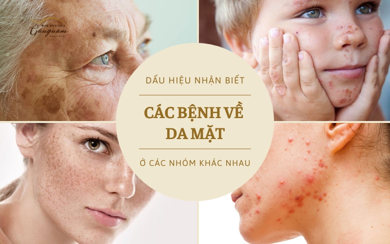 Các bệnh về da mặt có dấu hiệu nhận biết như thế nào và điều trị ra sao?