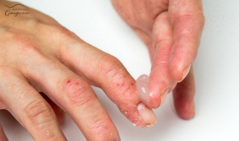 Thuốc bôi điều trị kháng khuẩn chống viêm khi da tay bị khô bệnh lý
