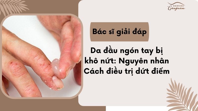 Da đầu ngón tay bị khô nứt vì sao? Cách điều trị nào hiệu quả nhất?