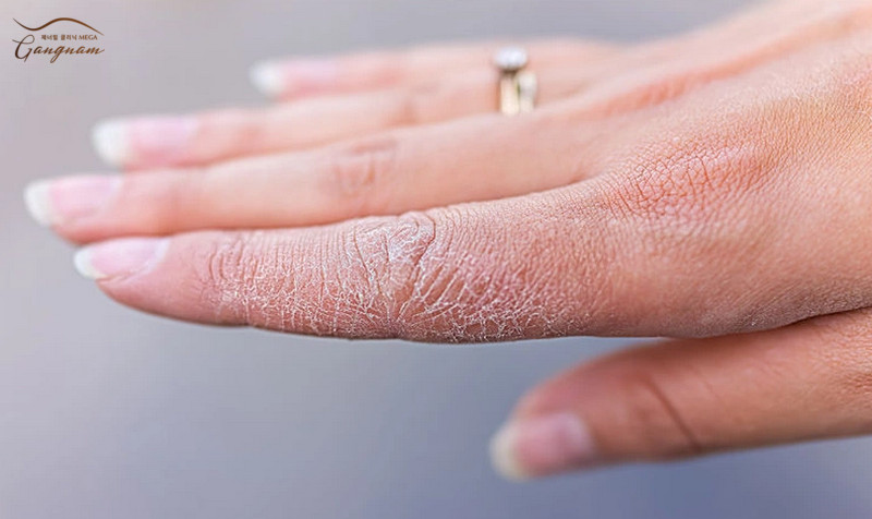 Nguyên nhân khiến da đầu ngón tay bị khô nứt là chăm sóc chưa đúng cách 