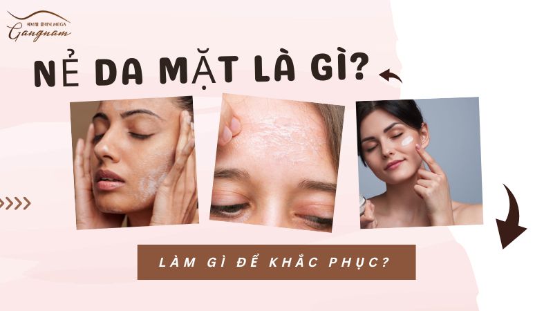 Nứt nẻ da mặt là gì? Làm sao để khắc phục