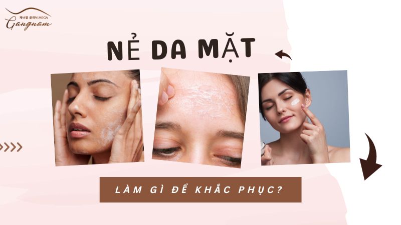 Nẻ da mặt làm gì để khắc phục