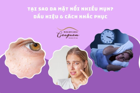 Tại sao da mặt nổi nhiều mụn? Dấu hiệu & cách khắc phục