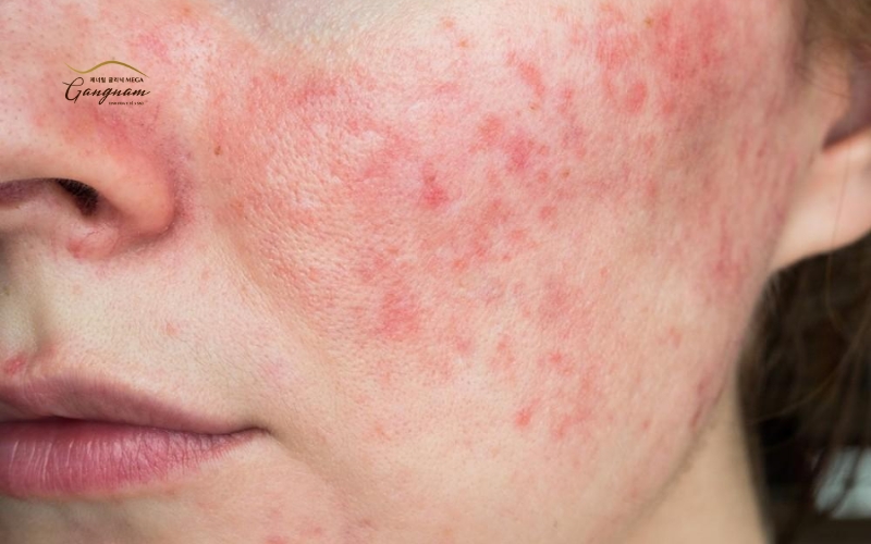 Các dấu hiệu thương tổn da mặt khi xông hơi sai cách hoặc dị ứng với anh và nguyên liệu đi kèm
