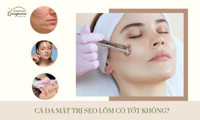 Cà da mặt trị sẹo lõm có an toàn hay không? Hiệu quả thực tế ra sao?