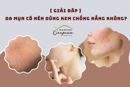 Da mụn có nên dùng kem chống nắng không?