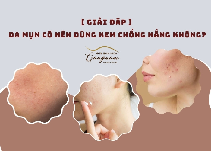 Da mụn có nên dùng kem chống nắng không?