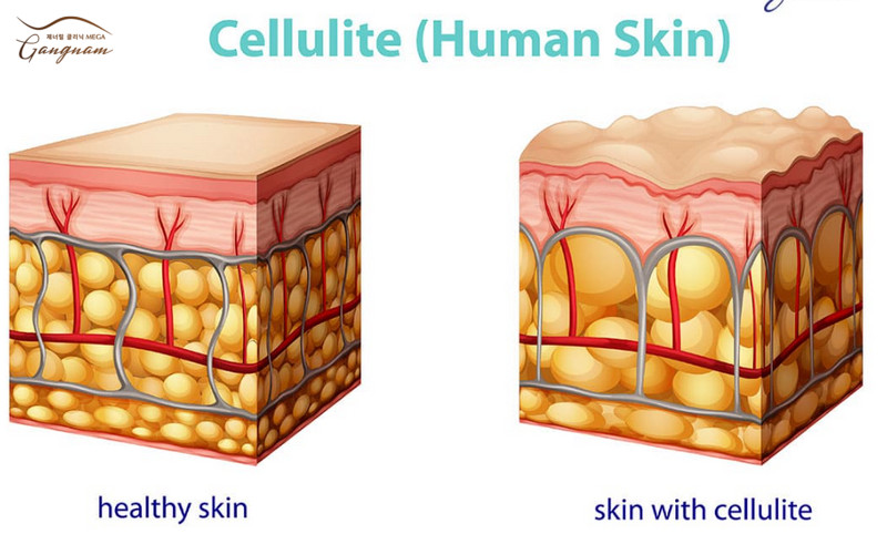 Biểu hiện tình trạng da sần vỏ cam