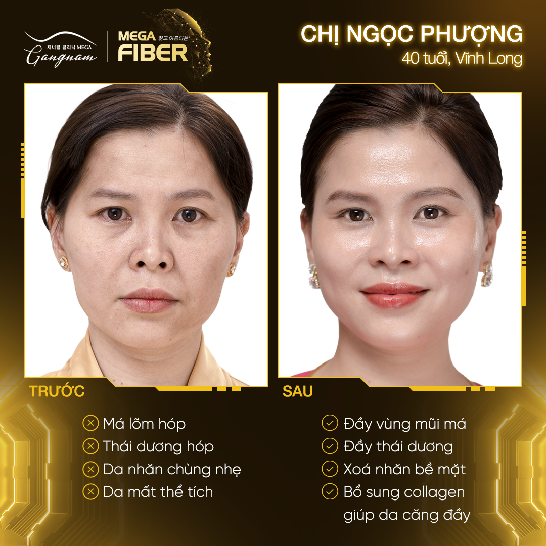 Chị Ngọc Phương cải thiện nếp nhăn, vùng má hóp rõ rệt