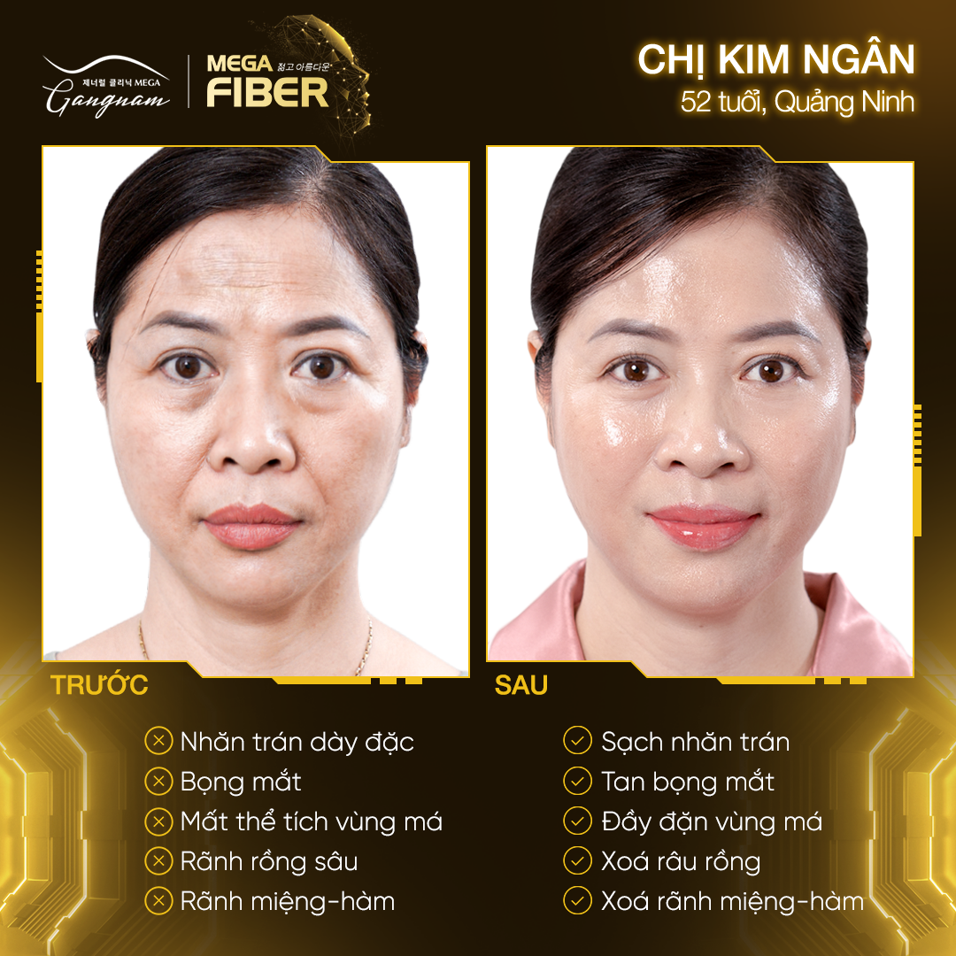 Chị Kim Ngân hoàn toàn hài lòng với kết quả nhận được sau Mega Fiber