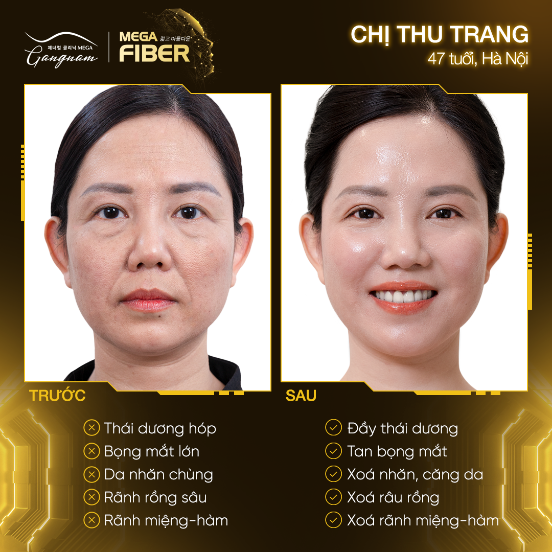 Sự thay đổi sau liệu trình căng da Mega Fiber chị Thu Trang