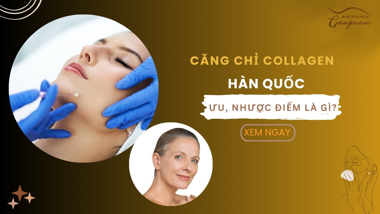 Căng chỉ collagen Hàn Quốc có ưu nhược điểm gì, ai nên thực hiện? 