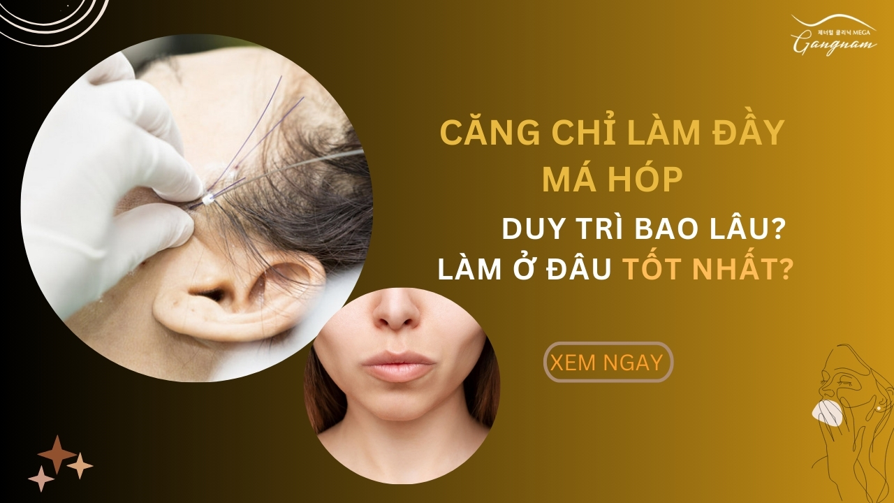 Căng chỉ làm đầy má hóp duy trì bao lâu và làm ở đâu tốt nhất?