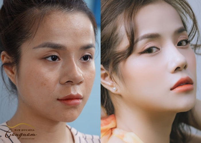 Căng mũi bằng chỉ có thể đạt được kết quả gì?